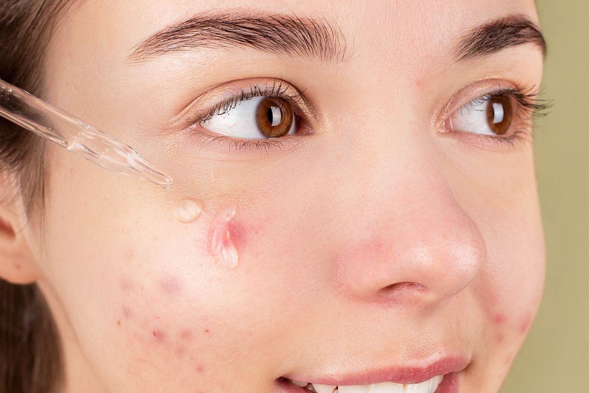 Application d un sérum à la pipette sur une peau à imperfections